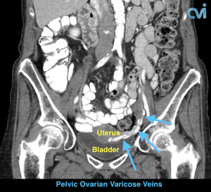 CT-coro-nal-300x273 (1)